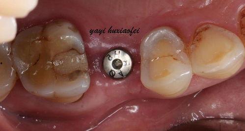 补牙过程视频成人图片,成人牙齿修复的直观解析